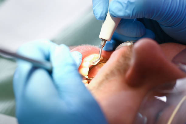 Best Chipped Tooth Repair Near Me  in Helmetta, NJ